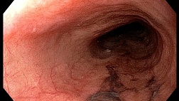 Сидероз пищевода: редкое клиническое наблюдение